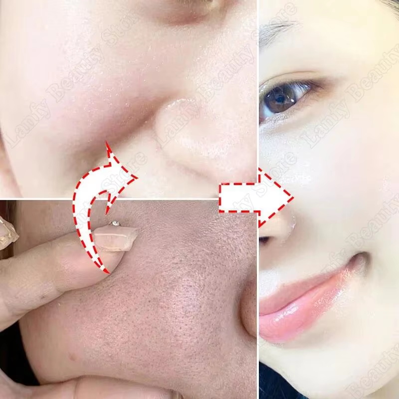 Salicylsäure Porenreinigungscr – Salicylic Acid Blackhead Remover Bewertung und Preis